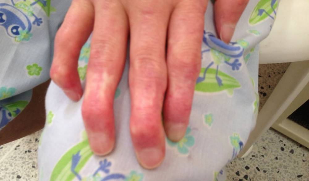¿Esclerodermia?