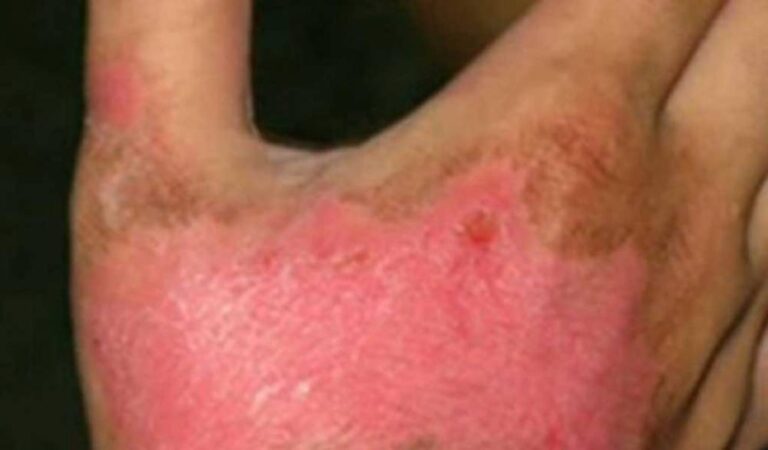 Más de 35 mil niños al año sufren lesiones por quemaduras en el país