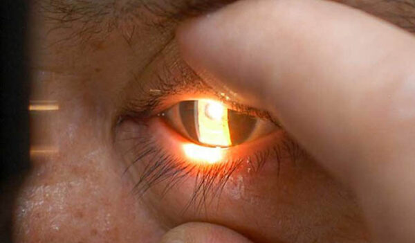 Glaucoma, problema de salud en México: oftalmólogos