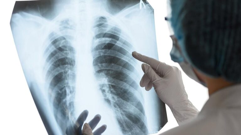 Suman 70 casos de tuberculosis