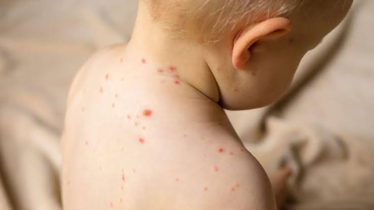 Alerta en Zacatecas por brotes de virus Coxsackie